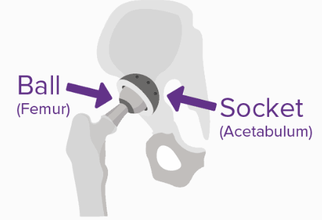 diagram of a hip replacement