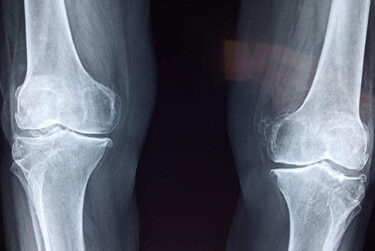 Xray of knees