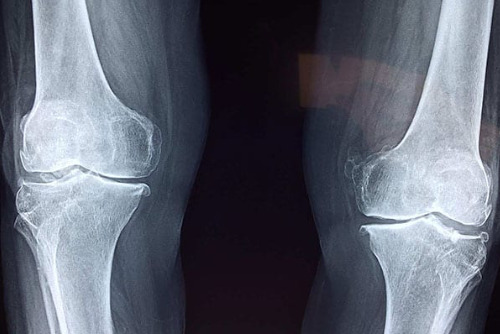X-Ray image of a patient's knees