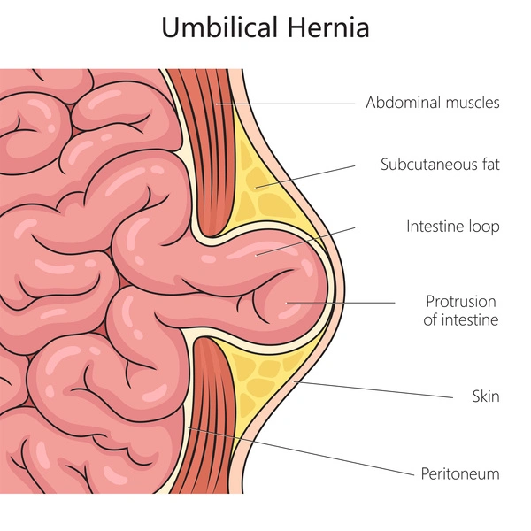 umbilical hernia