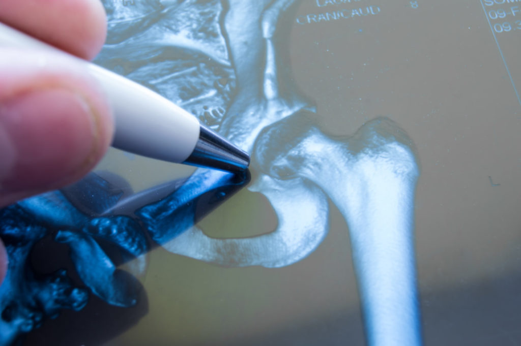 A pen pointing on a hip on an X-ray image