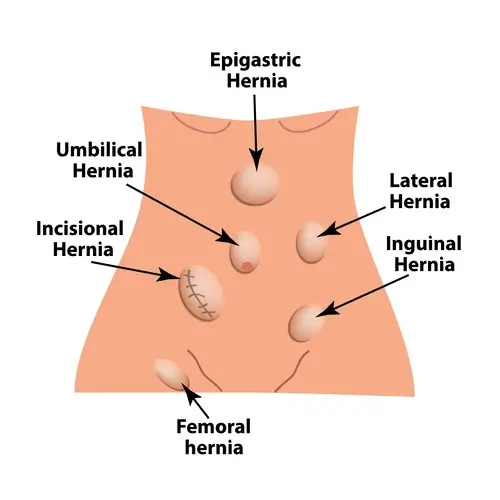 Diagram of different types of hernias
