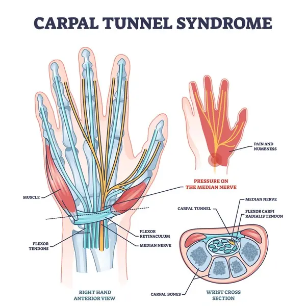 A diagram of carpal tunnel syndrome 