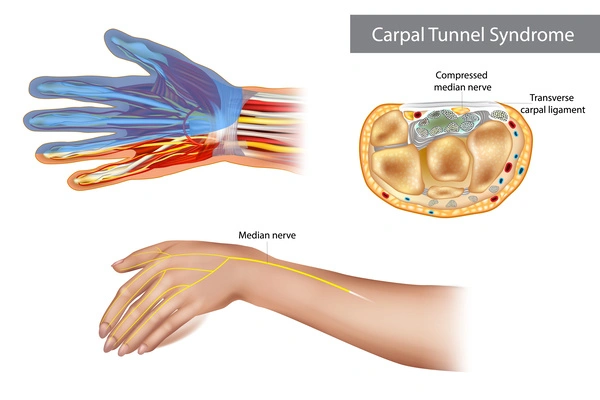 Diagram of carpal tunnel syndrome