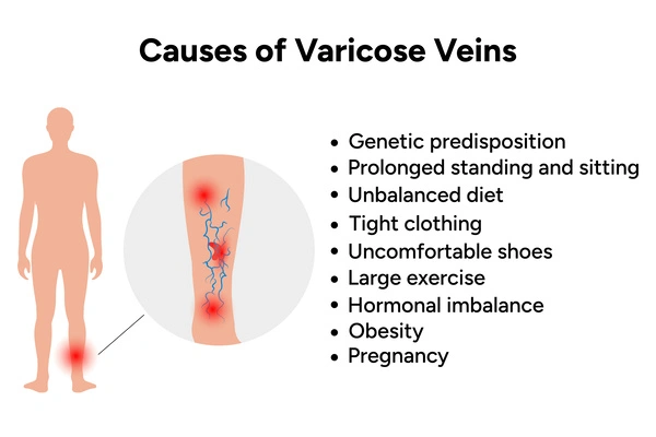 Diagram outlining the causes of varicose veins