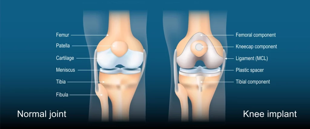 Diagram depicting a normal knee joint and a knee implant