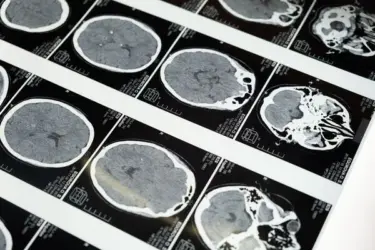 MRI scan results how long does take